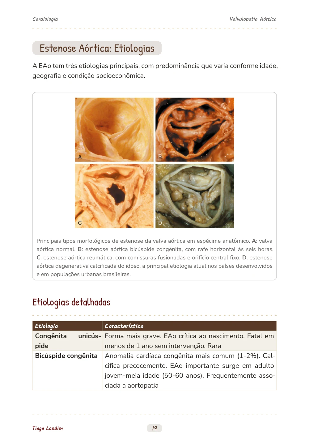Valvulopatia Aórtica