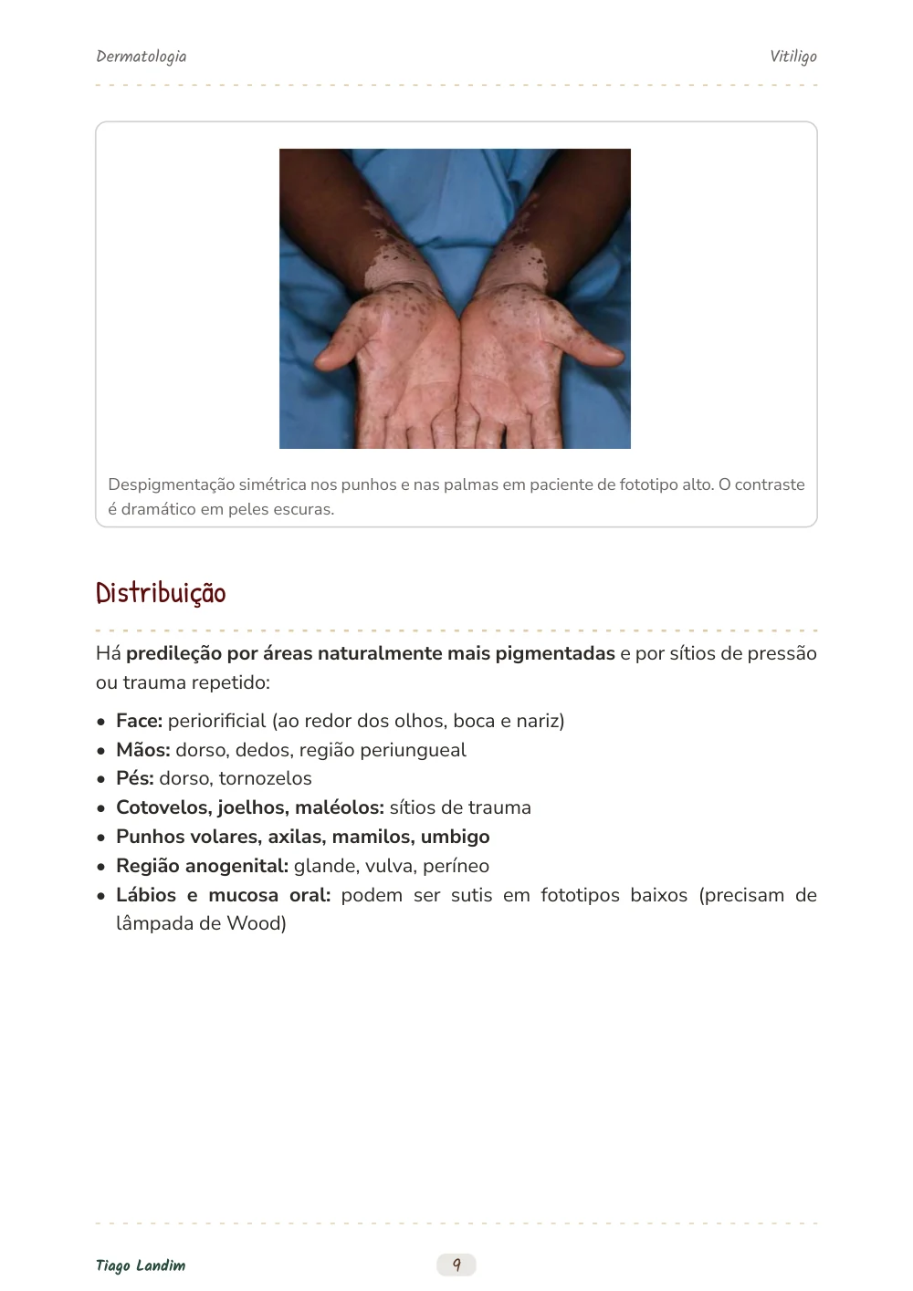Vitiligo