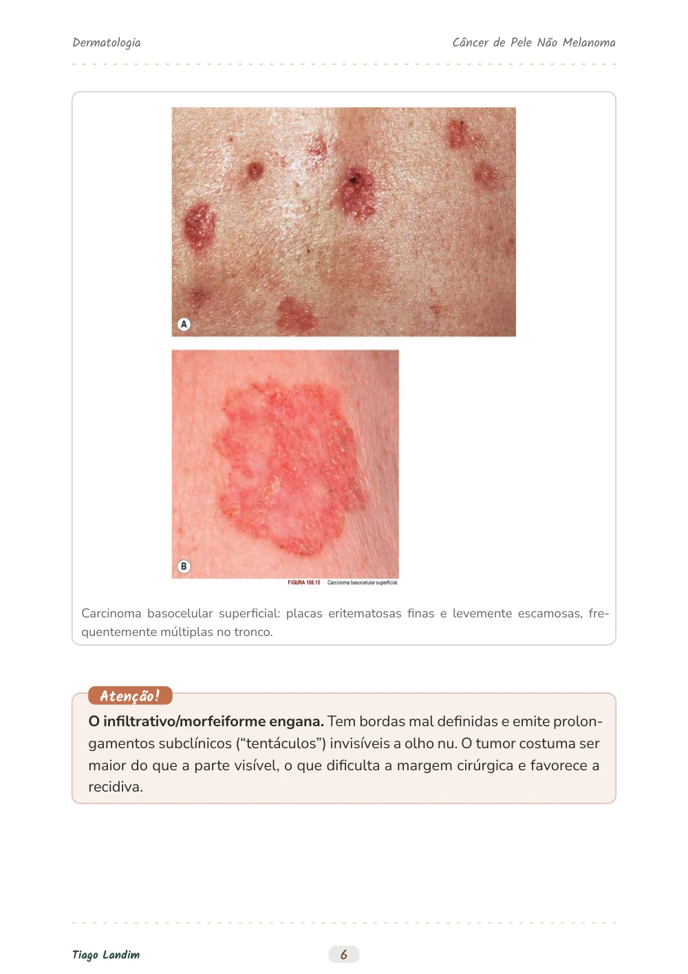 Câncer de Pele Não Melanoma