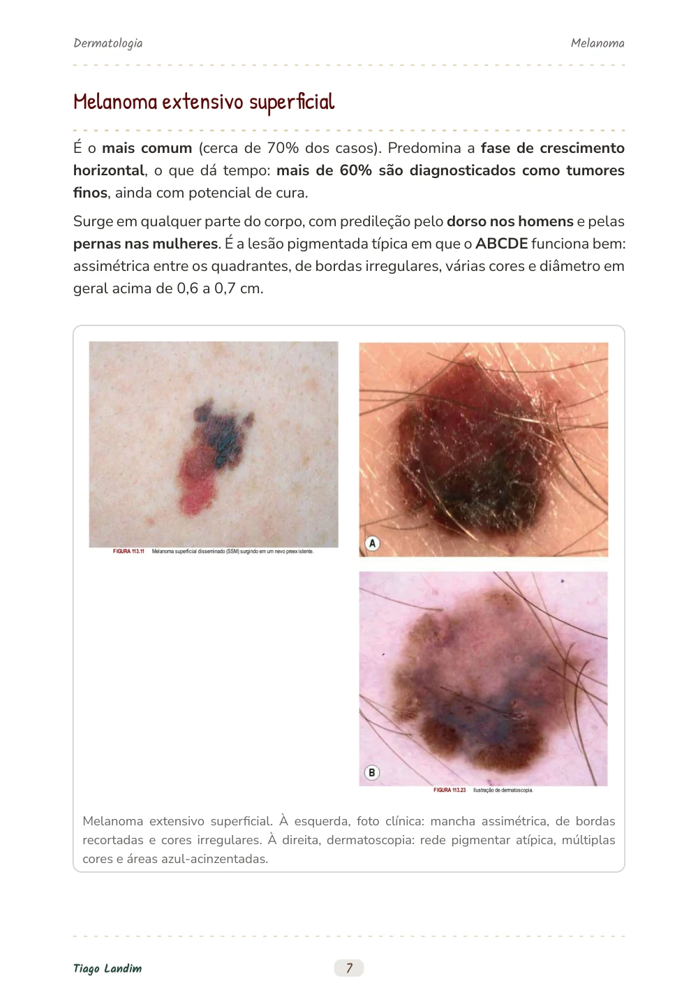 Melanoma