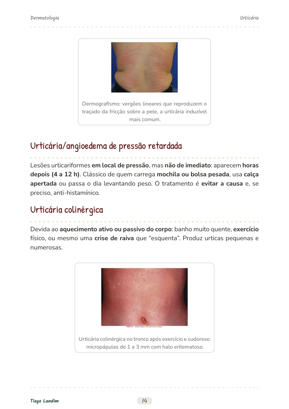 Urticária