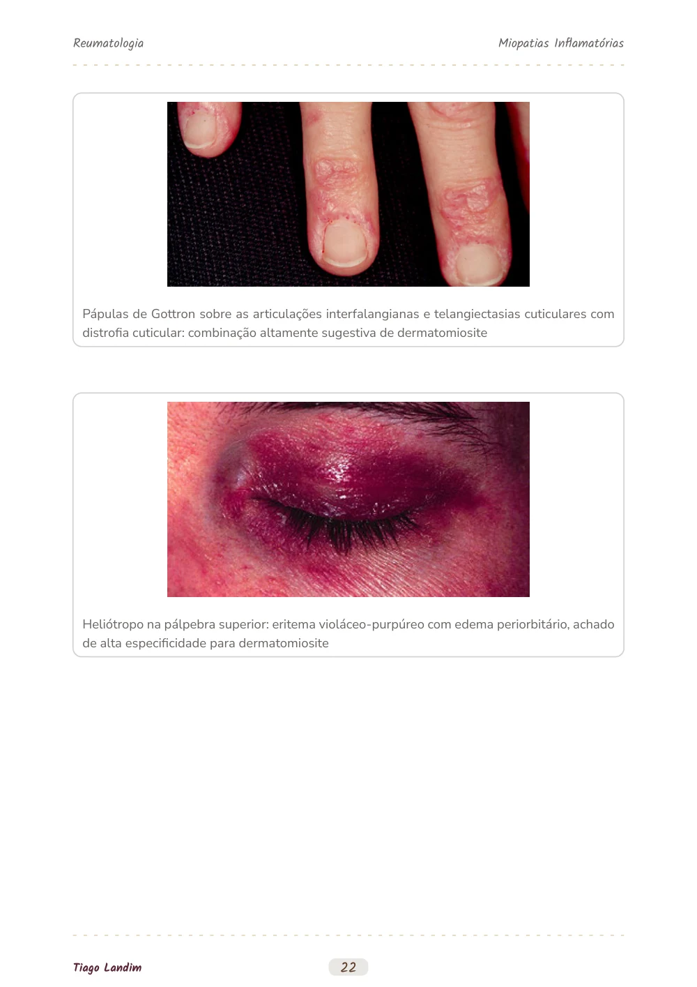 Miopatias Inflamatórias