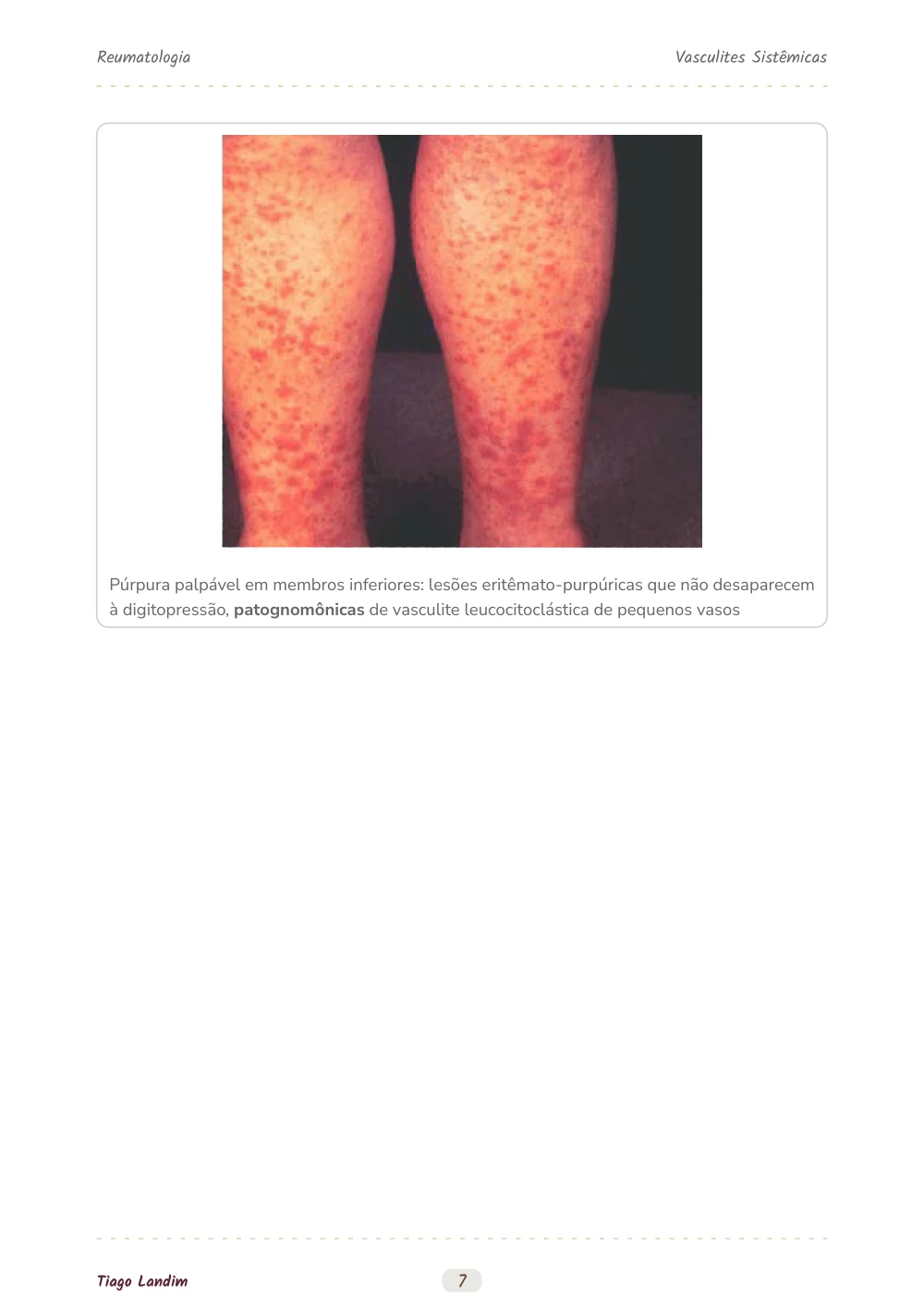 Vasculites Sistêmicas